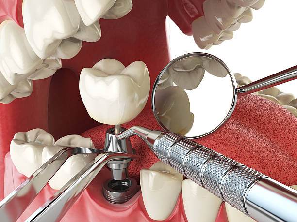 Best Emergency Wisdom Tooth Extraction in Port St Joe, FL